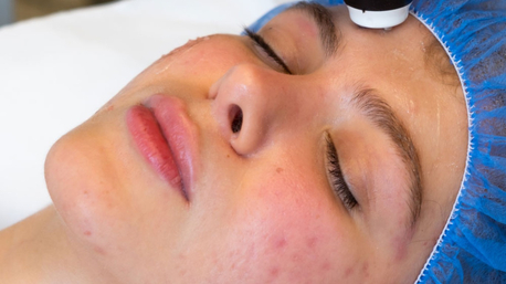 Mississauga, Business, Effective Hyperpigmentation Treatment For Clear, Even Skin Tone