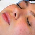 Effective Hyperpigmentation Treatment For Clear, Even Skin Tone