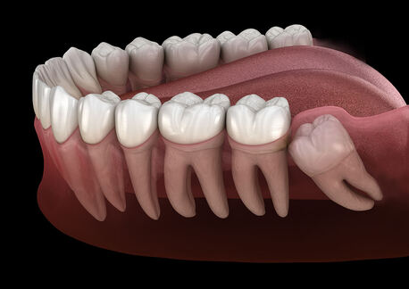 Noida, Health, Wisdom Tooth Removal In Noida By Expert Dentists