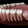 Wisdom Tooth Removal In Noida By Expert Dentists