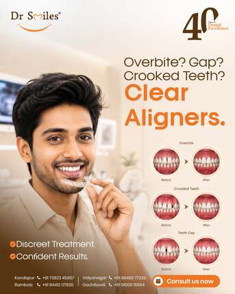 Hyderabad, Dental, Clear Aligners In Hyderabad &ndash; Dr Smiles Dental Clinic