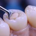Tooth Coloured Fillings In NIBM Pune | Natural-Looking Dental Fillings