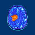 Hyperbaric Oxygen Treatment For Cancer | Supportive Wellness Therapy