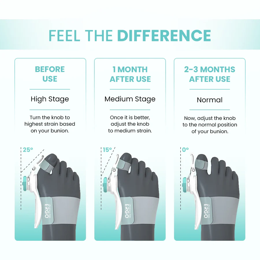 Ahmedabad, Health & Beauty Items, INR 1194,  Foot Bunion Corrector That Helps Realign Your Toes