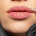 Lip Reduction Surgeon In Delhi For Natural And Balanced Facial Appearance