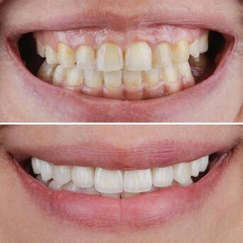 Satwa, Dental, Gummy Smile Treatment In Dubai &ndash; Advanced Cosmetic Dental Solutions