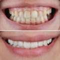 Gummy Smile Treatment In Dubai &ndash; Advanced Cosmetic Dental Solutions