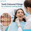 Tooth Coloured Fillings For A Natural Looking Smile