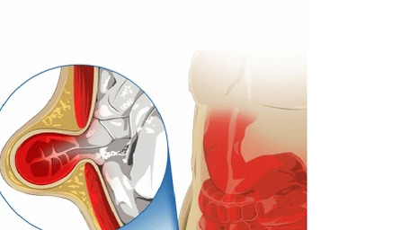 Chennai, Health, Affordable Hernia Surgery Cost In Chennai By The Best Laparoscopic And Keyhole Surgeons