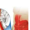 Affordable Hernia Surgery Cost In Chennai By The Best Laparoscopic And Keyhole Surgeons