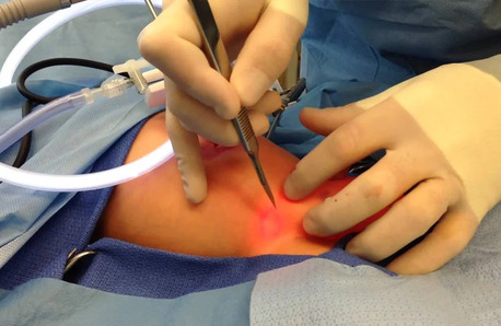 Chennai, Health, Affordable Hernia Surgery Cost In Chennai By The Best Laparoscopic And Keyhole Surgeons