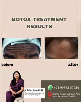 Visakhapatnam, Health, Rewind The Clock With Botox - Derma One Vizag