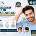 Best Hair Transplant In Gujarat In Ahmedabad