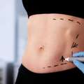 Advanced Abdominoplasty In Mumbai &ndash; Natural Results