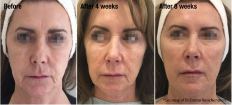 London, Beautician, Profhilo Leeds | Skin Rejuvenation & Hydration Treatment