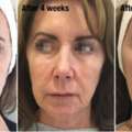 Profhilo Leeds | Skin Rejuvenation & Hydration Treatment