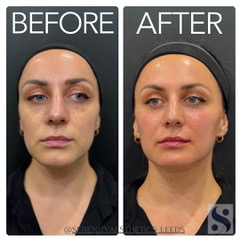 London, Beautician, Facial Rejuvenation | Full Face Aesthetic Treatments In Leeds