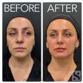 Facial Rejuvenation | Full Face Aesthetic Treatments In Leeds