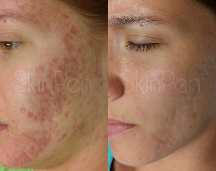 London, Beautician, Skinpen Microneedling | Advanced Skin Rejuvenation In Leeds