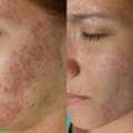 Skinpen Microneedling | Advanced Skin Rejuvenation In Leeds