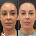 Tear Trough Filler Treatment | Under-Eye Rejuvenation In Leeds