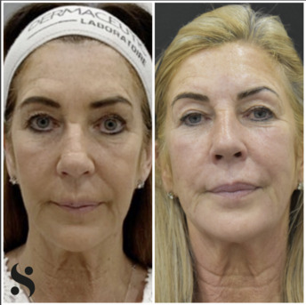 London, Beautician, Radio Frequency Skin Tightening | Non-Surgical Skin Lifting In Leeds