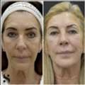 Radio Frequency Skin Tightening | Non-Surgical Skin Lifting In Leeds