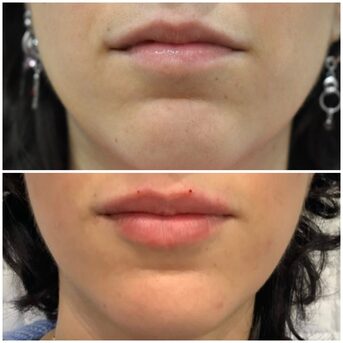 London, Beautician, Dermal Fillers Leeds | Lip & Facial Enhancement Treatments
