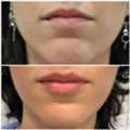 Dermal Fillers Leeds | Lip & Facial Enhancement Treatments