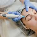 RF Microneedling Benefits For Reducing Fine Lines And Wrinkles