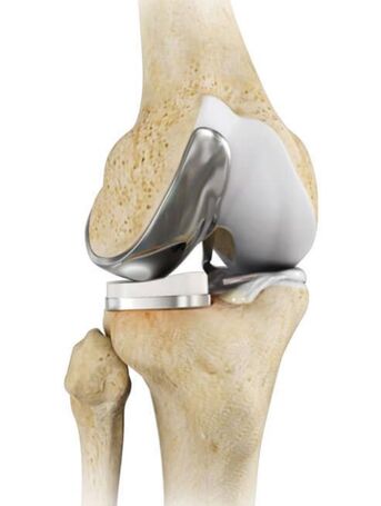 Ahmedabad, Health, Robotic Unicondylar Knee Replacement