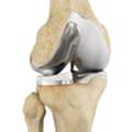 Robotic Unicondylar Knee Replacement