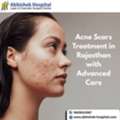 Acne Scars Treatment In Rajasthan With Advanced Care