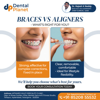 Hyderabad, Dental, Root Canal Treatment In Tellapur | Dental Planet