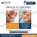 Root Canal Treatment In Tellapur | Dental Planet