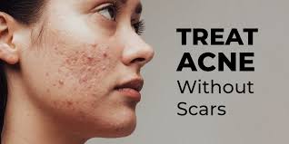 Mumbai, Health, What Causes Acne And How Can Expert Skin Care Help?
