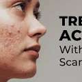 What Causes Acne And How Can Expert Skin Care Help?