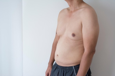 Mumbai, Health, Best Gynecomastia Surgery In Mumbai By Experienced Surgeons