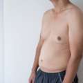 Best Gynecomastia Surgery In Mumbai By Experienced Surgeons