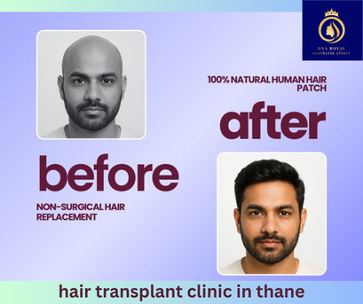 Thane, Fashion & Design, Hair Transplant Clinic In Thane &ndash; Expert Hair Restoration At DNA Royal.