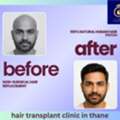 Hair Transplant Clinic In Thane &ndash; Expert Hair Restoration At DNA Royal.
