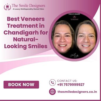 Chandigarh, Dental, Best Veneers Treatment In Chandigarh For Natural-Looking Smiles