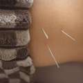 Natural Wellness With Acupuncture San Francisco Services
