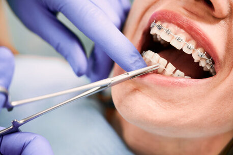 Mumbai, Dental, Braces Treatment Cost In Pune |Get Teeth Braces Starting At ₹29,999
