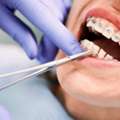 Braces Treatment Cost In Pune |Get Teeth Braces Starting At ₹29,999