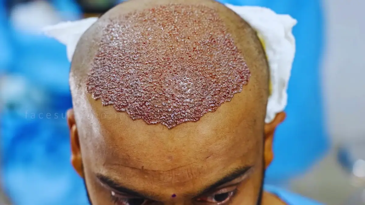 Ahmedabad, Health, Hair Transplant In Ahmedabad