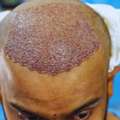 Hair Transplant In Ahmedabad