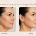 Why Winter Is Ideal For A Non-Surgical Facelift In Sydney