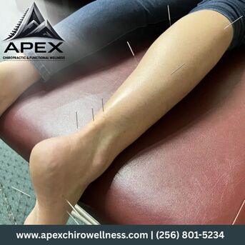 Austin, Health, Dry Needling In Hampton Cove | Apex Chiropractic & Functional Wellness