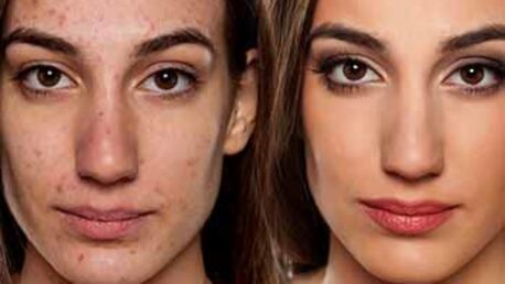 London, Health & Beauty Items, Enhance Your Profile With Non-Surgical Rhinoplasty Chiswick